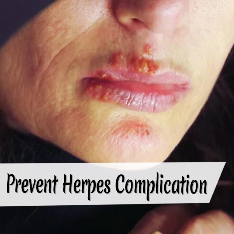 Herpes Healer Kit