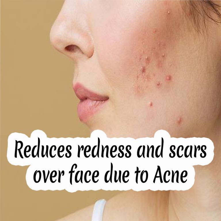 Acne Healer Kit