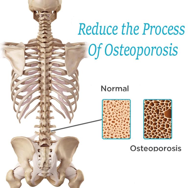 Osteoporosis Healer Kit